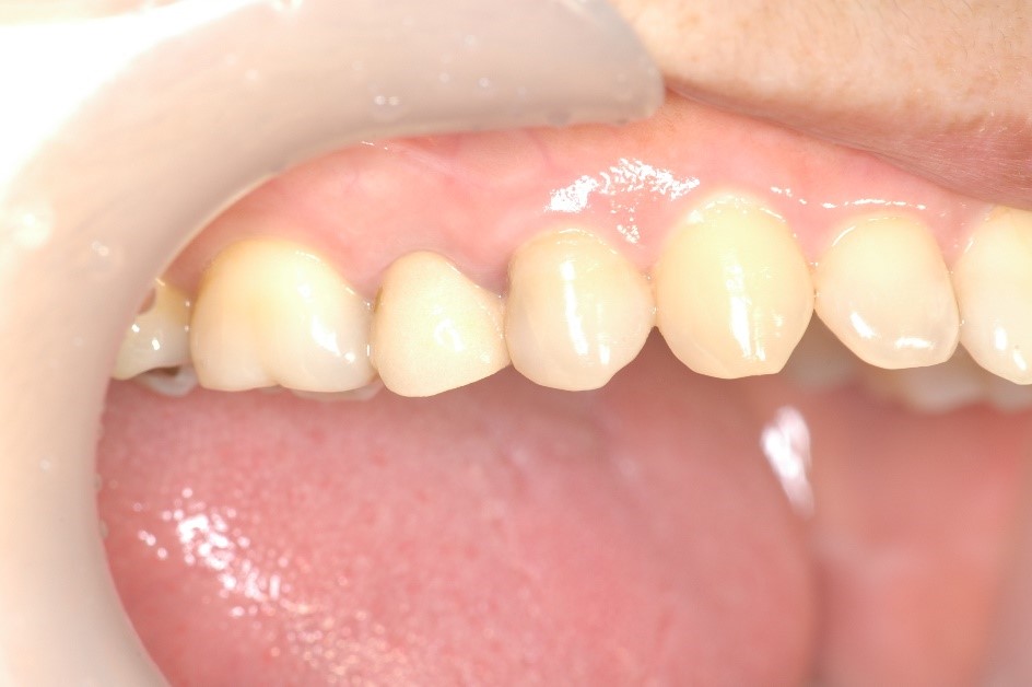セラミック奥歯の症例⑫ 30代女性
