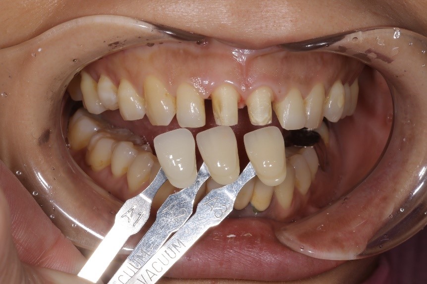 セラミックス前歯の症例⑭20代女性