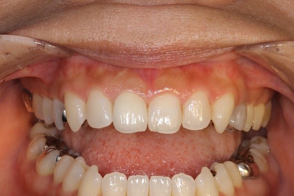 インプラント前歯の症例①40代女性