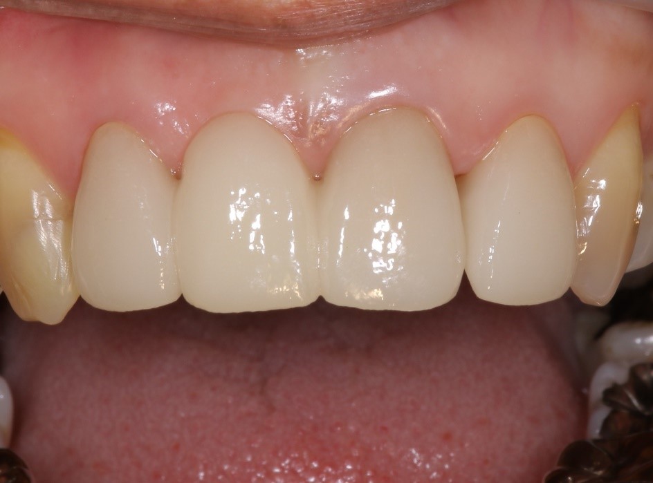 セラミックス前歯の症例⑫40代女性