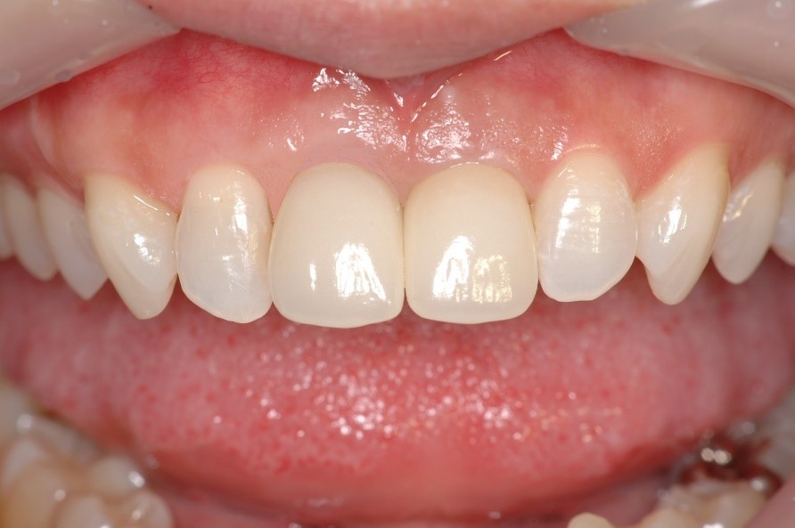 インプラント前歯の症例②30代女性