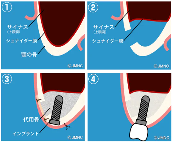 サイナスリフト法