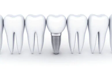 インプラント治療は、健康な歯を再構築してしっかり噛んで食べられるようにすることが最大の目的です。そして、顎の骨に固着させるものですから、どれほど長い間使い続けることができるのかも重要なポイントになります。あいり歯科クリニックでは、高い技術力をもとにインプラント手術の成功率98%を誇っています。装着後の寿命も長く、定期的なケアを受けていただいて快適に過ごしている患者さまがたくさんいらっしゃいます。 インプラント治療では、骨の状態、人工歯根の本数や噛み合わせなどを考慮し、総合的な治療計画を立てる必要があります。さらに、インプラント治療は高い技術力が要求される治療法です。当院の院長は、国際インプラント学会認定医であり、大学病院でも長くインプラント治療を行ってきています。あいり歯科クリニックでは、かみ合わせにも配慮した治療を行っていますので、力のコントロールでインプラントを破折・破損させることはありません。そして、インプラントを長く快適に保つために最も大切なのは、治療終了後のメンテナンスです。メンテナンスは、ご自宅での正しいブラッシングといったホームケアと、定期的に受ける検診やクリーニングです。これにより、インプラントを長く快適な状態に保つことができますし、残された歯や歯肉の健康も守ることができます。インプラントは歯周病になった際の進行が早いため、特に歯周病予防は重要です。歯周病を放置していると顎の骨が溶けていき、残された歯が次々に抜けてしまう可能性もあります。そのためにもきちんとホームケアを行い、定期的に検診を受けることが不可欠です。なお、この定期検診は保険適用で受けられます。