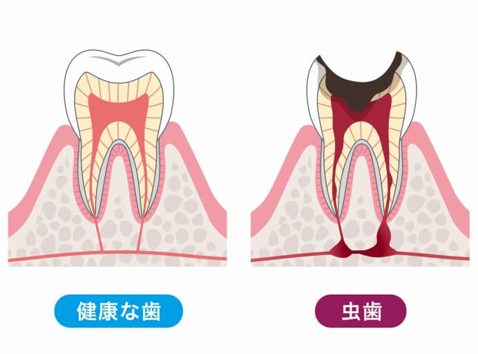 痛みの少ないむし歯治療