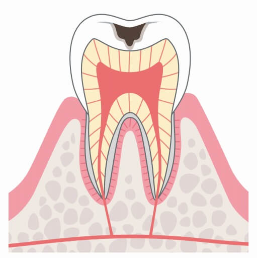 C2:象牙質のむし歯