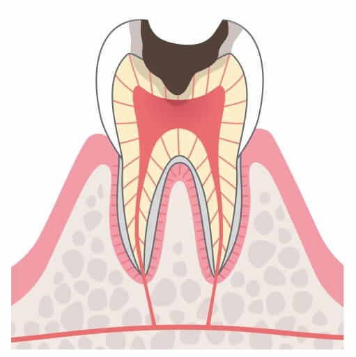 C3:神経に達したむし歯