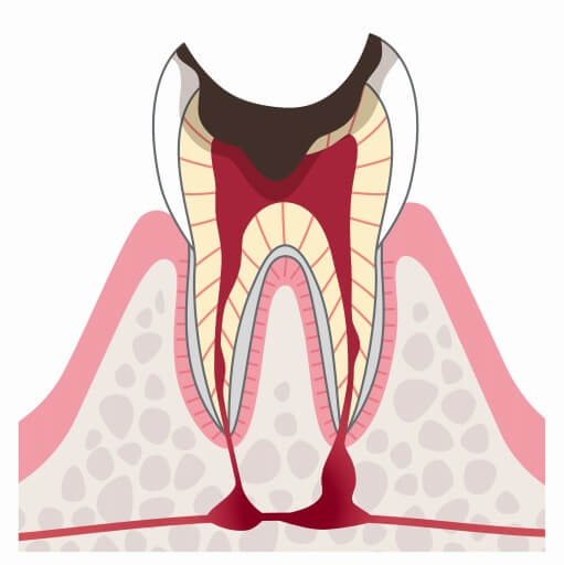 C4:歯根に達したむし歯