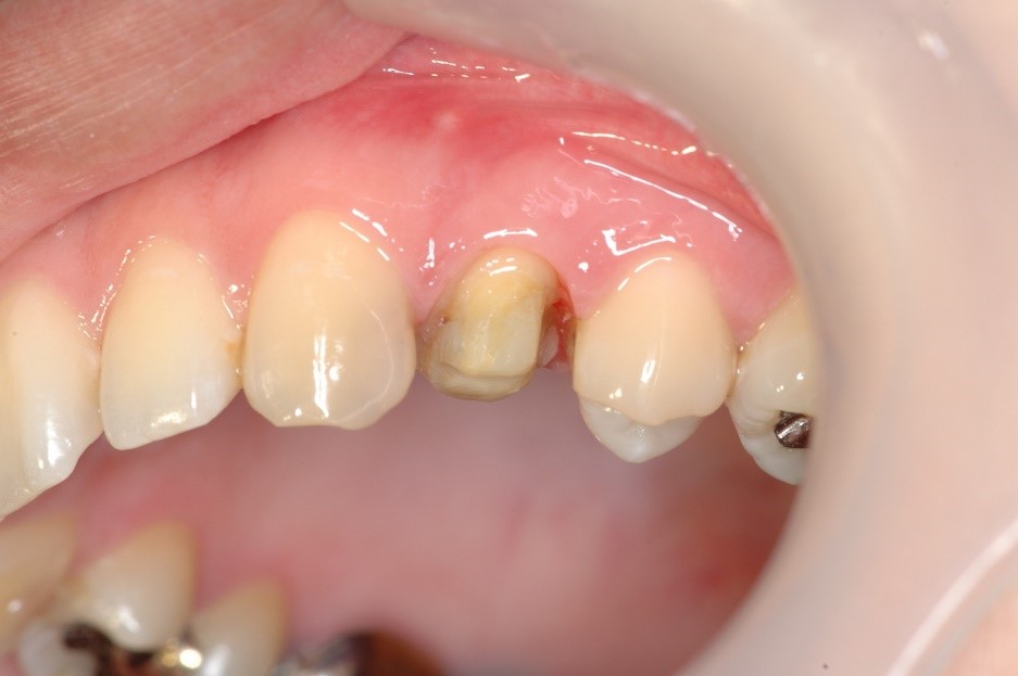 セラミック奥歯の症例⑩ 20代女性