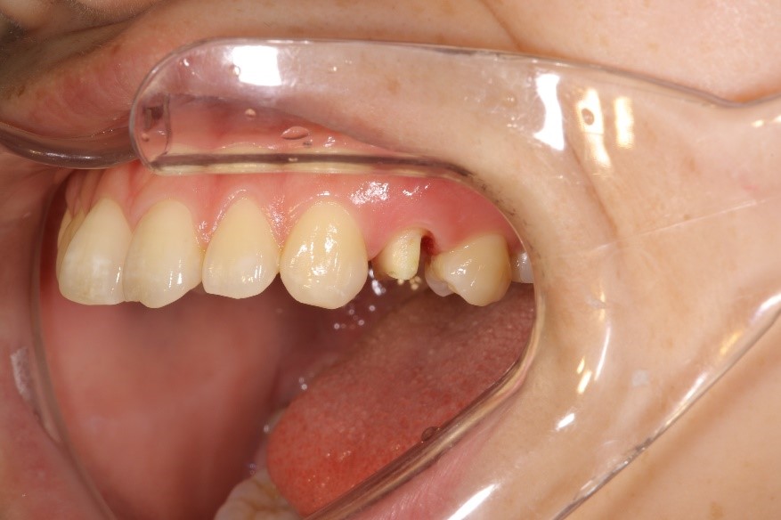 セラミック奥歯の症例⑦ 20代女性