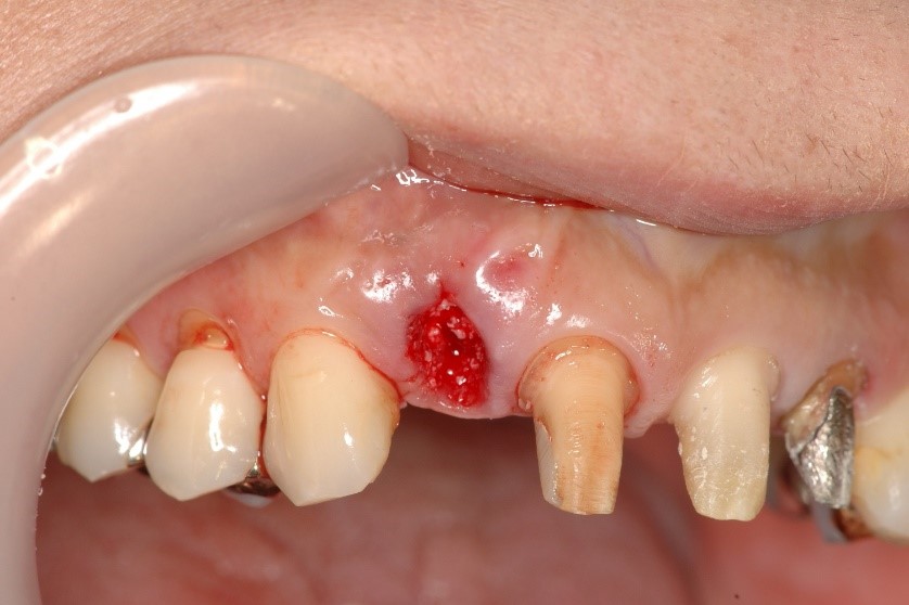 セラミックスの前歯の症例④50代女性