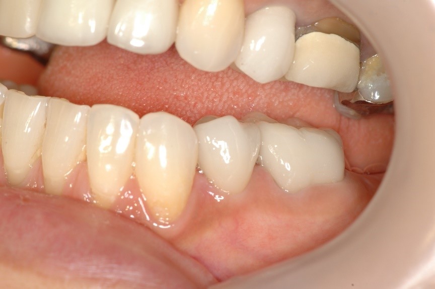セラミック奥歯の症例⑧ 50代女性