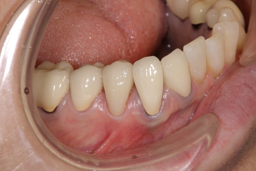 セラミック奥歯の症例⑤ 50代女性