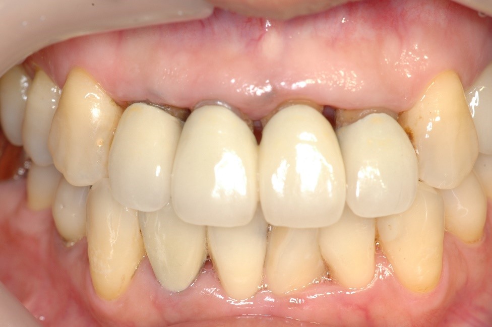 セラミックス前歯の症例⑬40代女性
