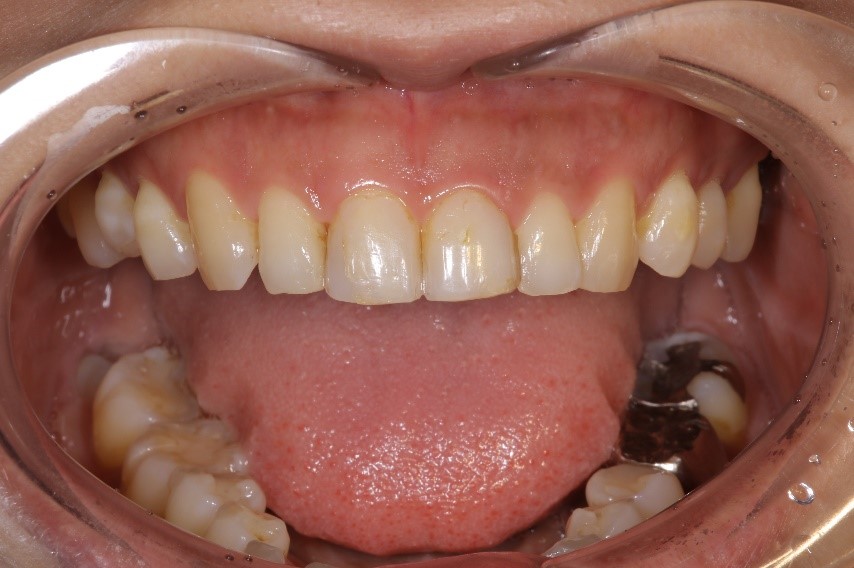 セラミックス前歯の症例⑭20代女性