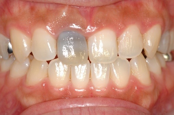 インプラント前歯の症例①40代女性