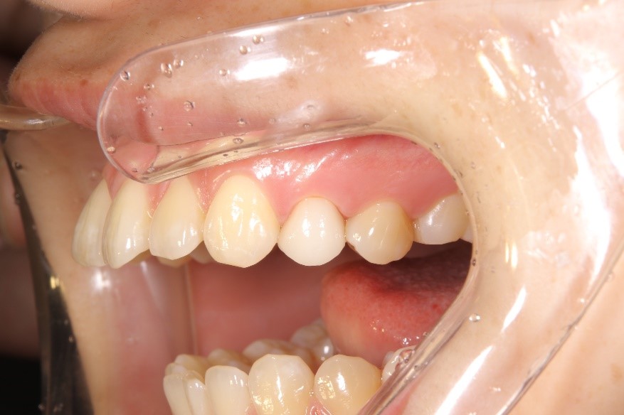 セラミック奥歯の症例⑦ 20代女性